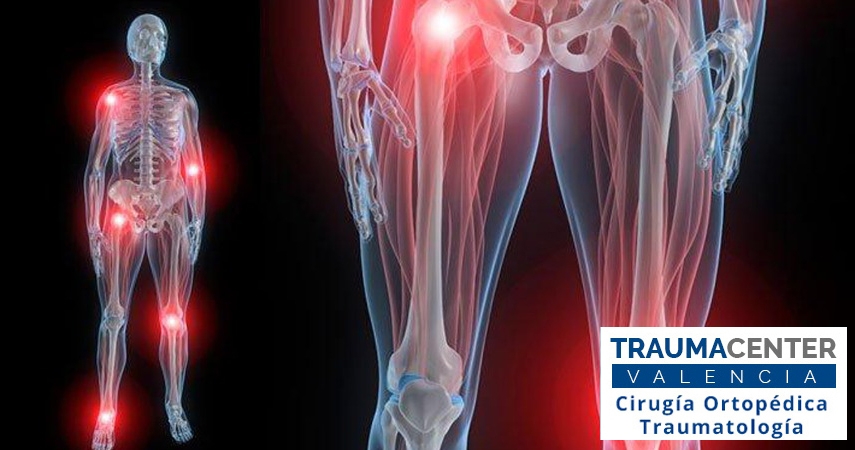 La osteotomía para tratar la artritis